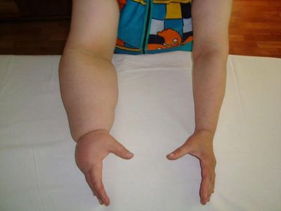 Understanding Peripheral Vascular Disease and Lymphoedema: A Comprehensive Guide
