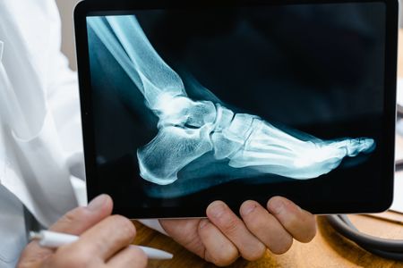 Bunion Surgery - Indications, Procedure & Recovery