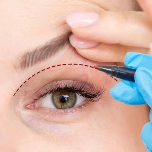 How Eyelid Surgery Changed My Life: A Personal Perspective