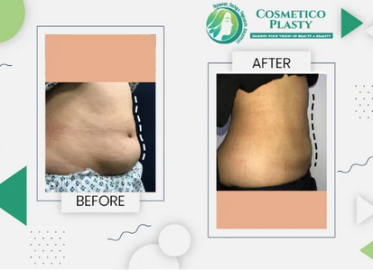 How to Choose the Right Liposuction Clinic in Lahore?
