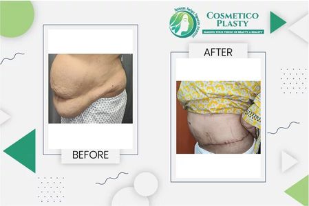Everything You Need to Know About Tummy Tuck Surgery and Cost