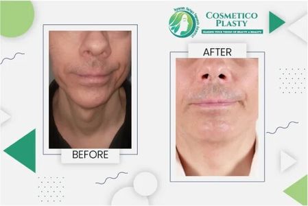 Everything You Should Know About Facelift Surgery in Pakistan