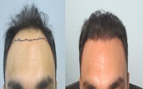 The Ultimate Guide to Hair Transplant Procedures in Riyadh