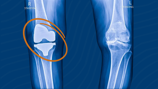 5 Key Factors Influencing Knee Replacement Cost in Pakistan