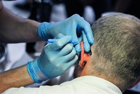Best Clinics for Hair Transplant Turkey Procedures