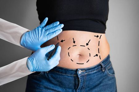 Restore Your Shape with a Tummy Tuck in Riyadh