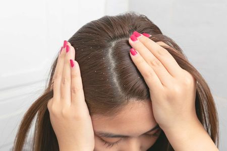 Anti Dandruff Shampoo: A Complete Scientific Guide