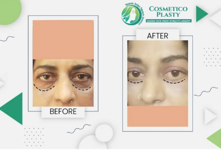 Eyelid Surgery in Lahore: Everything You Need to Know Before You Decide