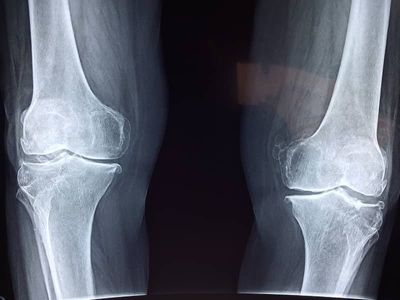 Effective Knee Pain Treatment in Lahore: Top Solutions for Relief and Recovery