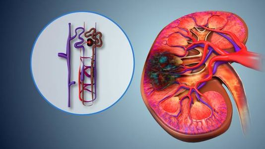The Impact of Sleep Disorders on CKD: Understanding the Link Between Kidney Function and Rest