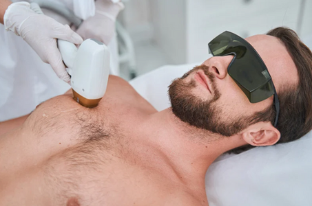Laser Hair Removal for Men: Growing Trends and What to Expect