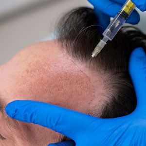 Factors That Influence Hair Transplant Pricing