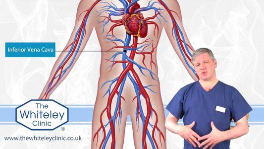 Treatment Options for May-Thurner Syndrome in Santa Fe