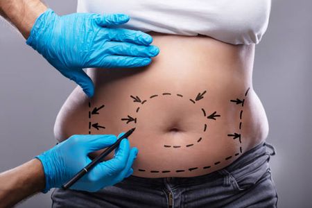 How Liposuction in Riyadh Transforms Body Contours