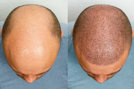 Hair Transplant in Dubai: Your Path to Fuller, Natural Hair