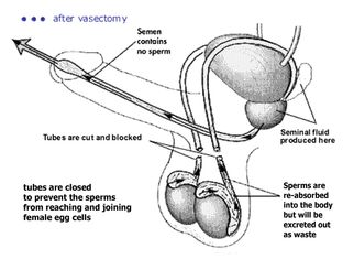 Affordable Vasectomy Options: Finding the Best Value for Your Procedure
