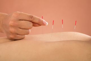 Discover the Power of Acupuncture in Milton: A Modern Approach to Holistic Healing