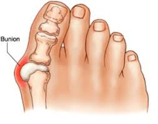 Bunions: What We Treat at Foot Focus Podiatry