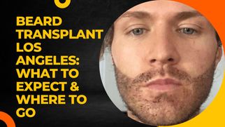 Beard Transplant Los Angeles: What to Expect &amp; Where to Go