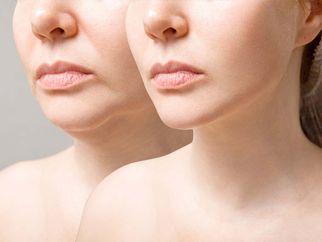 How can dermal fillers enhance your natural beauty?