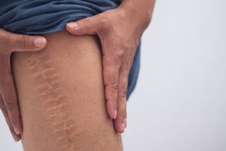 Keep It Flawless: Cosmetic Scar Treatments in Dubai