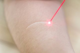 Get Rid of Old Scars with Laser in Dubai