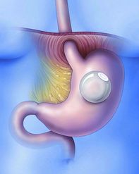 Explore the Advantages of Gastric Balloon in Riyadh