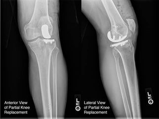 Knee Replacement Cost in Lahore: Everything You Need to Know