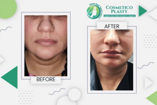How to Choose the Right Surgeon for Facelift in Lahore