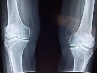Effective Knee Pain Treatment in Lahore: Top Solutions for Relief and Recovery