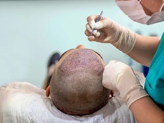 How FUE Transplants Deliver Lasting Results