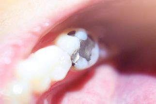 The Shift Toward Mercury-Free Dentistry